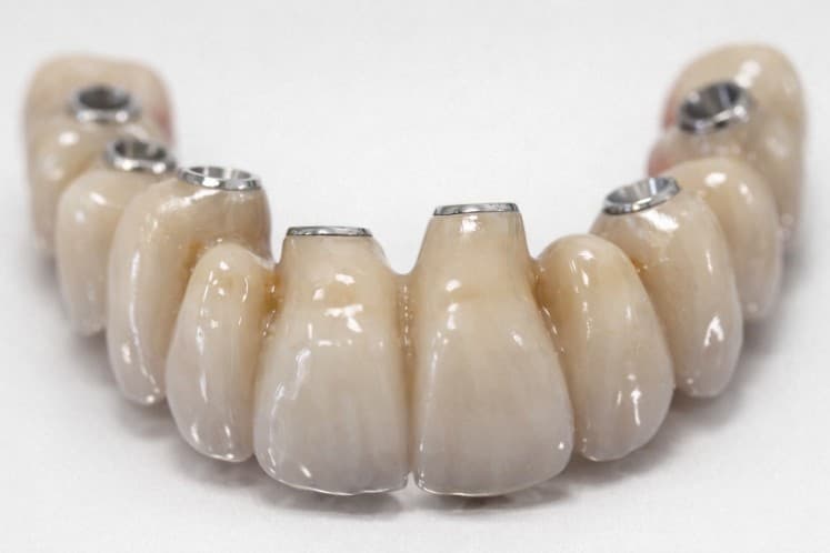 Prothèse implanto-portée numérique